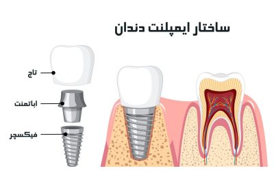 اباتمنت دندان چیست؟ مزایا و معایب و انواع آن
