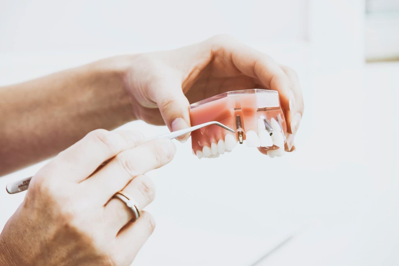 اباتمنت در کاشت ایمپلنت دندان