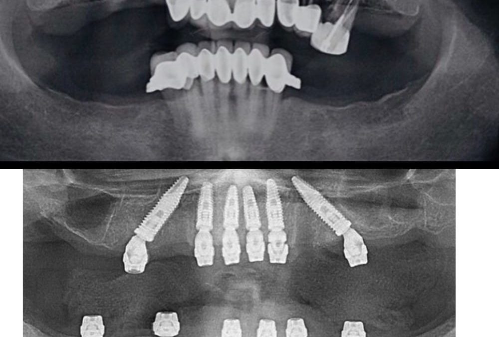 طول عمر ایمپلنت دندان چقدر است ؟