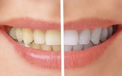 عوارض بلیچینگ دندان و راه های رفع آن