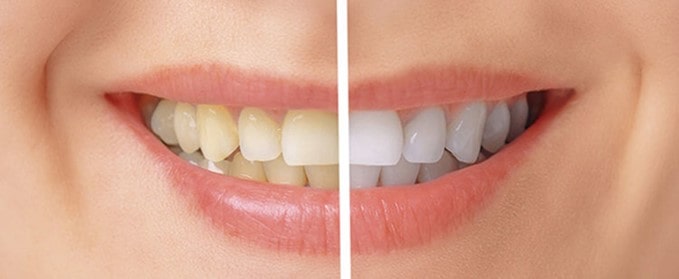 عوارض بلیچینگ دندان چیست