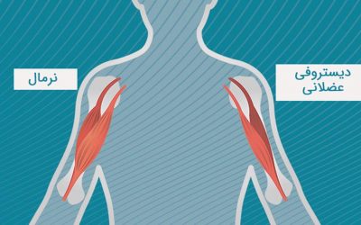 دیستروفی عضلانی چیست؟ انواع، تشخیص و درمان