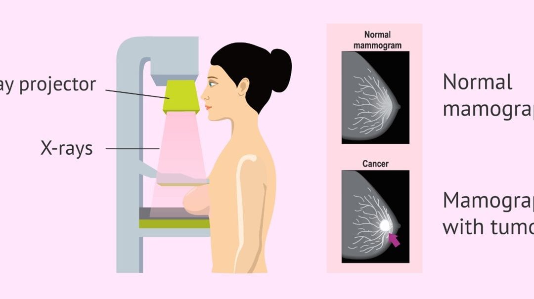 عوارض ماموگرافی چیست؟