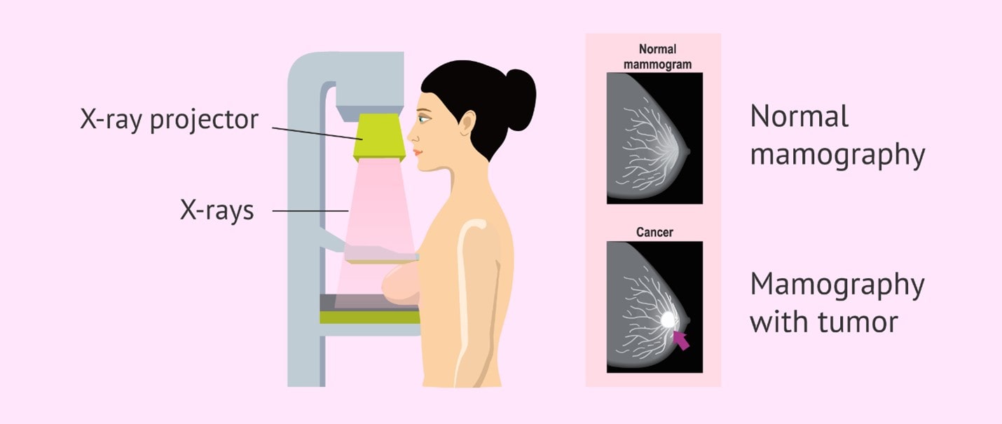 عوارض ماموگرافی