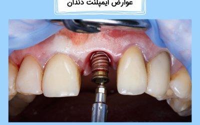 درباره عوارض ایمپلنت دندان بیشتر بدانید