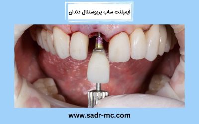 ایمپلنت ساب پریوستئال دندان چیست؟