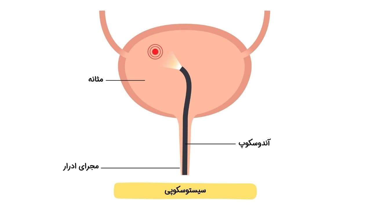 سیستوسکوپی سیستوسکوپی