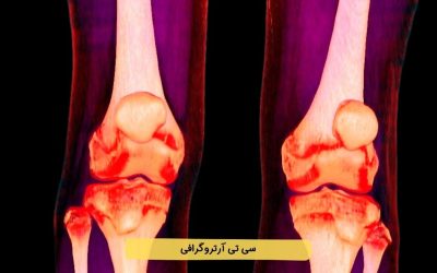 درباره سی تی آرتروگرافی بیشتر بدانید