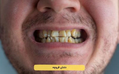درباره دندان قروچه بیشتر بدانید