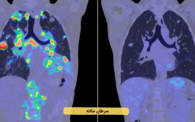 درباره سرطان مثانه بیشتر بدانید