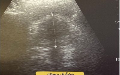 درباره سونوگرافی پروستات بیشتر بدانید
