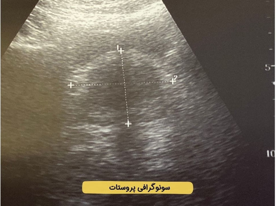 سونوگرافی پروستات سونوگرافی پروستات