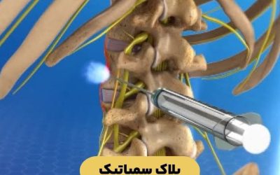 درباره بلاک سمپاتیک بیشتر بدانید