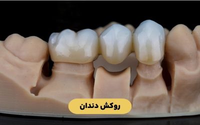 درباره روکش دندان بیشتر بدانید