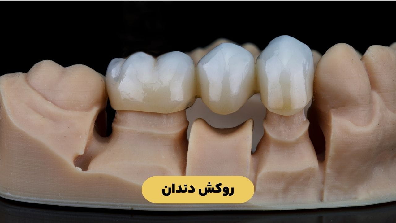 روکش دندان روکش دندان