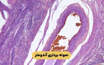 درباره بیوپسی یا نمونه برداری آندومتر بیشتر بدانید