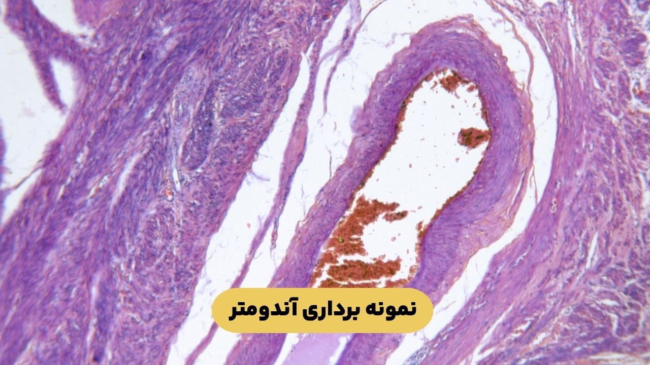 نمونه برداری آندومتر نمونه برداری آندومتر