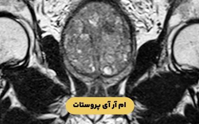 ام آر آی پروستات: چیست؟ کاربرد و نحوه انجام