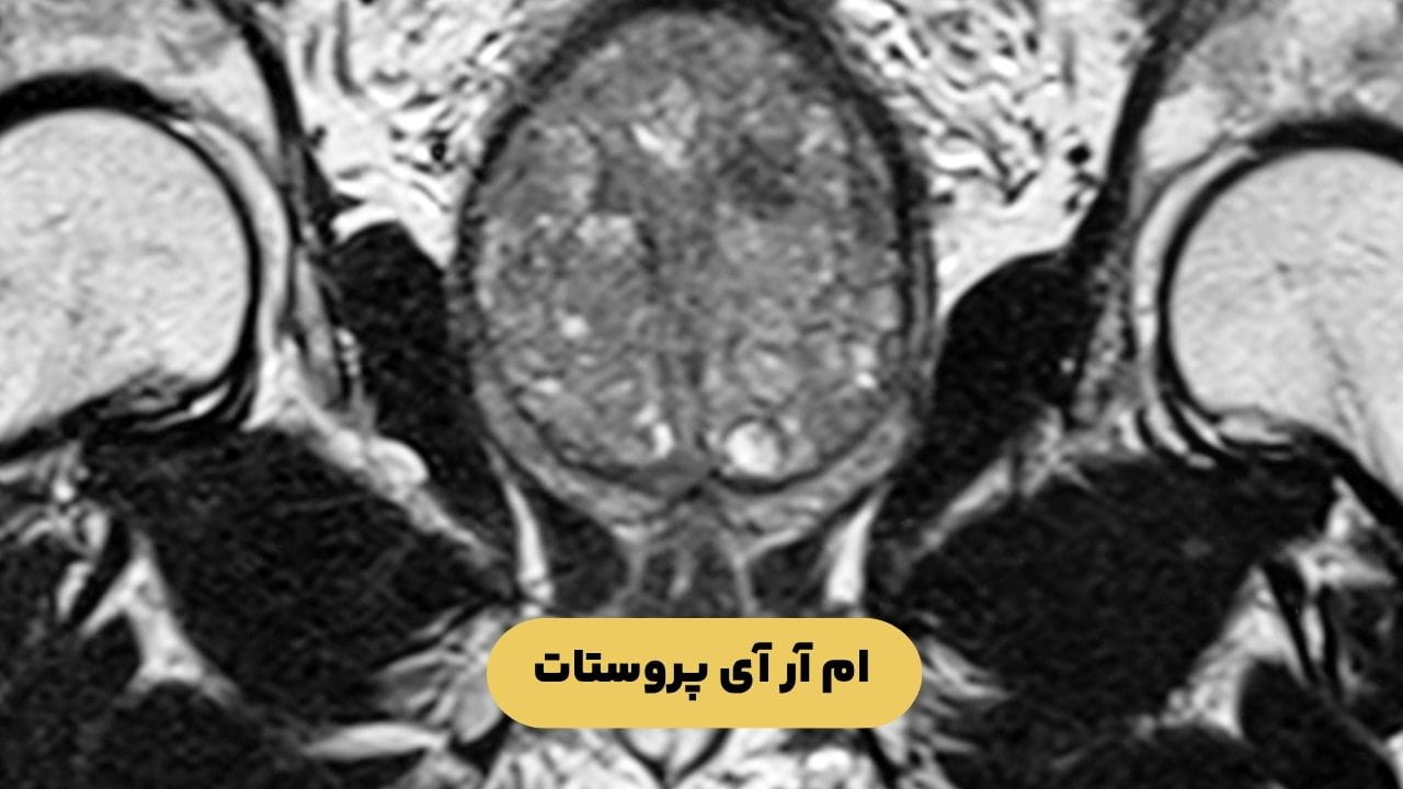 ام آر آی پروستات ام آر آی پروستات