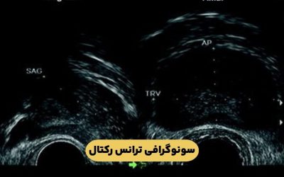 درباره سونوگرافی ترانس رکتال بیشتر بدانید