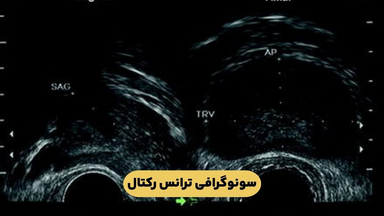 سونوگرافی ترانس رکتال سونوگرافی ترانس رکتال
