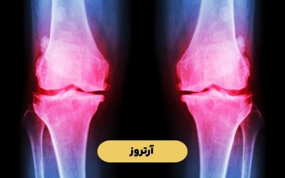 درباره آرتروز یا استئوآرتریت بیشتر بدانید