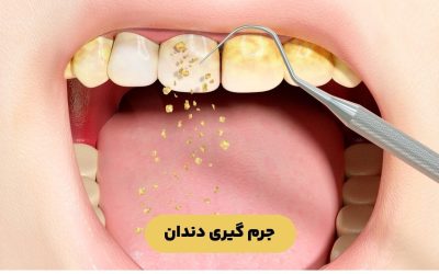 درباره جرم گیری دندان بیشتر بدانید